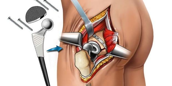 Double Hip Replacement